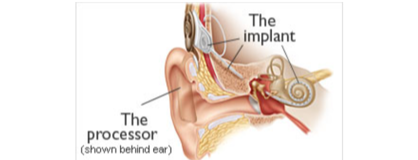Southern Cochlear Implant Program